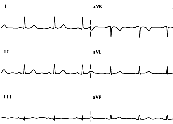 ecg_norm_arti.gif (5292 byte)