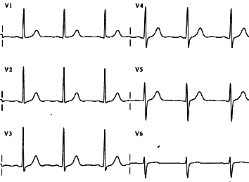 ecg_norm_perif.gif (8331 byte)