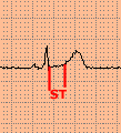 st.gif (1889 byte)